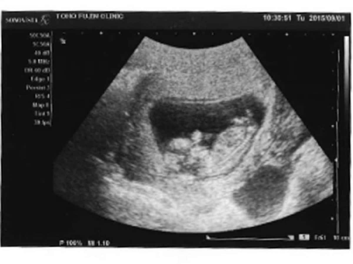 妊娠中に胸が張る症状で赤ちゃんの性別がわかるって本当？ image 2